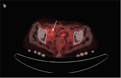 The role and effect of FDG-PET/CT on patient management and restaging of bladder carcinoma