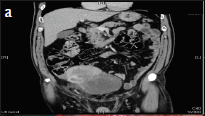 Acute urinary retention due to solitary fibrous tumor of the abdominal wall