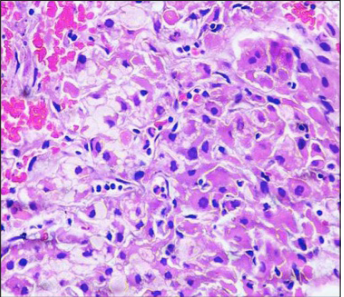 Case report of everolimus-induced sustained partial response in metastatic renal epithelioid angiomyolipoma
