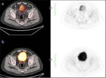The influence of post-diuretic late phase imaging in visual and quantitative evaluation of urothelial tumors by F-18 fluorodeoxyglucose positron emission tomography/computed tomography