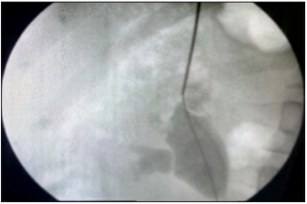 Safety and efficacy of supracostal superior calyceal approach for percutaneous renal surgery